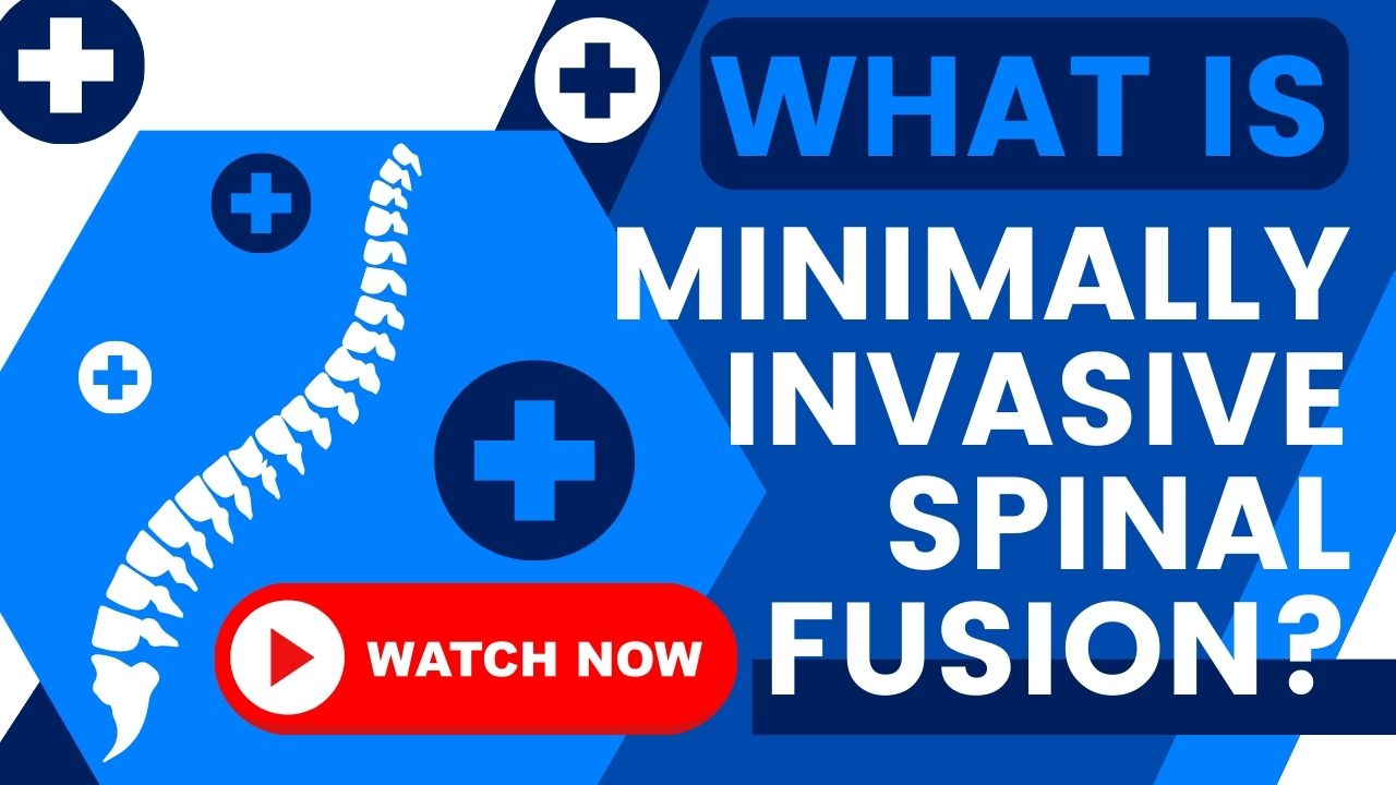 Illustration of minimally invasive spinal fusion procedure showing small incisions and instrumentation
