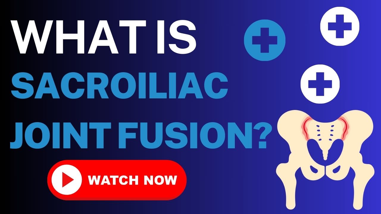 Medical illustration showing titanium implants across the sacroiliac joint to create a fusion